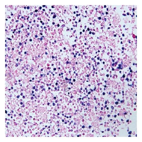 Cytology of pericardial fluid. (a) Diff-Quick stain (×400) shows ...