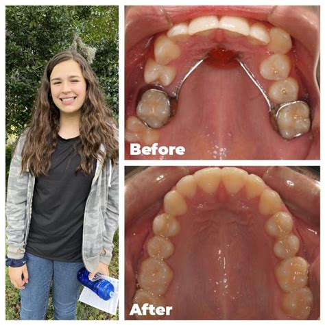 Top 103 Pictures Palate Expander Before And After Photos Stunning