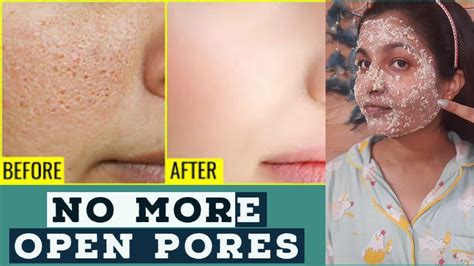 How To Get Rid Of Large Open Pores Permanently 100 Working Youtube