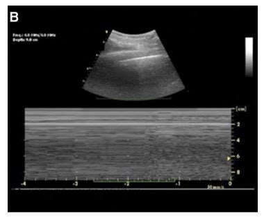 Lung Point Of Care Ultrasound OpenAnesthesia