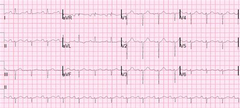 Dr. Smith's ECG Blog: Tachycardia with Pericardial Effusion