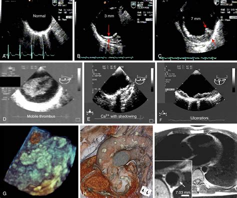 Aortic Atherosclerosis and Embolic Events – Clinical Tree