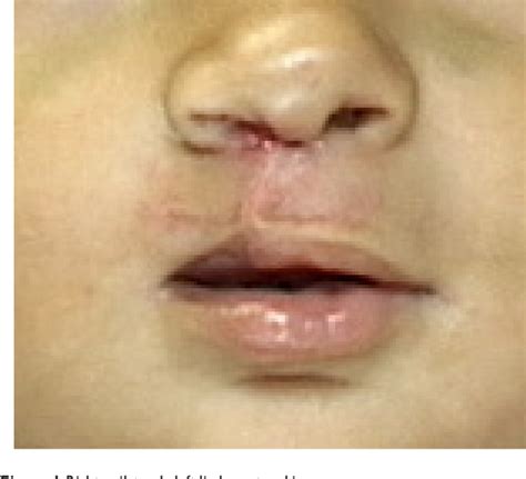 Figure 1 From Hypertrophic Scarring In Cleft Lip Repair A Comparison