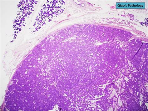 Basal Cell Adenoma Of The Parotid Gland Flickr