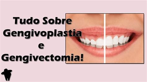 Aula De Periodontia Tudo Sobre Gengivoplastia E Gengivectomia