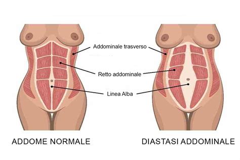 Diastasi Addominale Quali Sono I Sintomi E Come Prevenirla