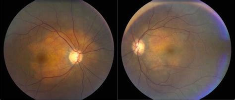 Ocular Manifestations Of Sarcoidosis Intechopen