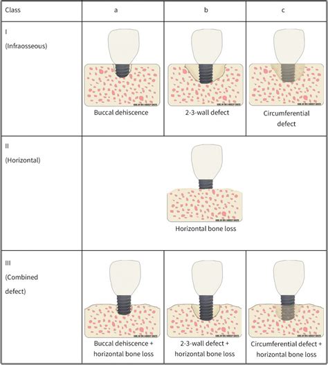 Dental Peri Implant Diseases ITI Blog