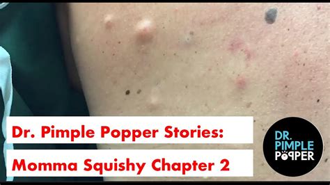 Dr Pimple Poppers Weekly Story Time Momma Squishy Chapter 2 Youtube