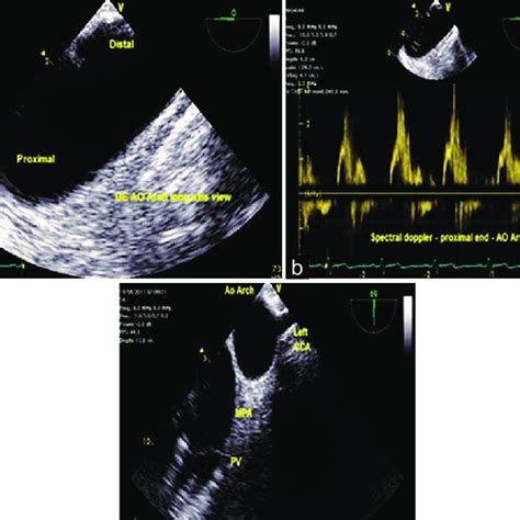 Mid Esophageal Aortic Valve Long Axis View Demonstrating An Artifact