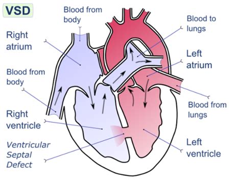 Congenital Heart Defects Flashcards Quizlet