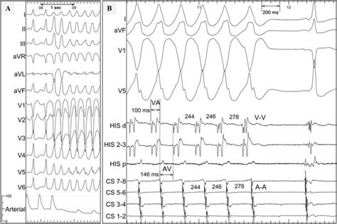 A Lead Ecg Demonstrating The Onset Of A Fast And Hemodynamically