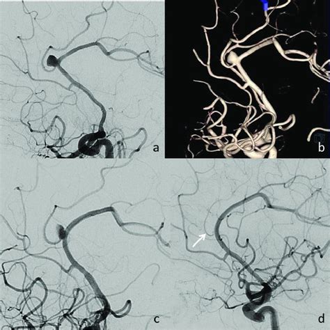 A 56 Year Old Woman With Headache A B Digital Subtraction Angiography