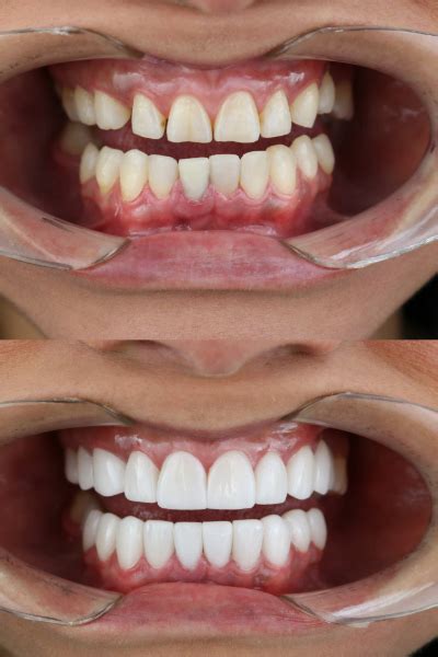 Diferentes Precios De Carillas Dentales Doctor Jhon Rojas