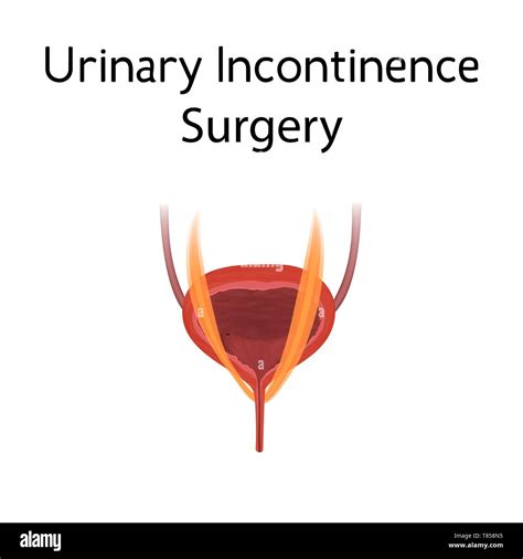 Urinary incontinence surgery, illustration Stock Photo - Alamy