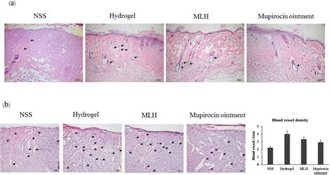 Histological Evaluation In Post Burn Full Thickness Wound Section Of