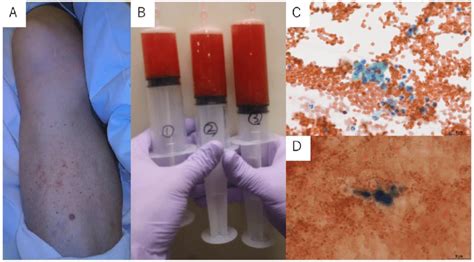 A Purpuric Lesions On The Patients Lower Extremity B Download Scientific Diagram