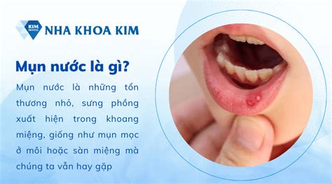 Nổi mụn nước trong miệng là bệnh gì