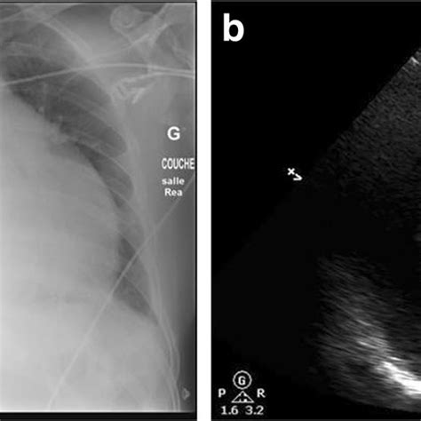 A Chest X Ray Showing Enlarged Cardiac Silhouette B Pocus Picture