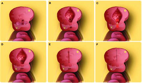 Laparoscopic Extra Vesical Repair Schematic Main Steps Of This