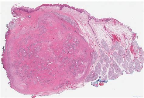 Intraductal Carcinoma Of The Salivary Glands Ottawa Atlas Of Pathology