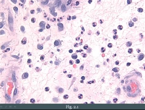 Pathoma Chapter 2 Inflammation Wound Healing Flashcards Quizlet