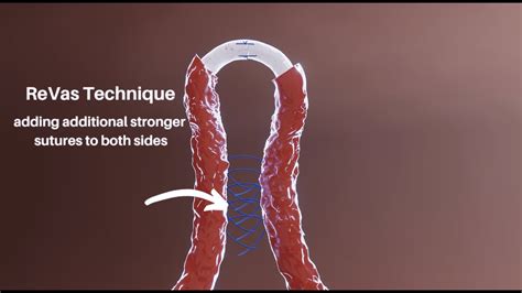 Vasectomy Reversal Reinforcing Vasal Suture Revas Technique Youtube