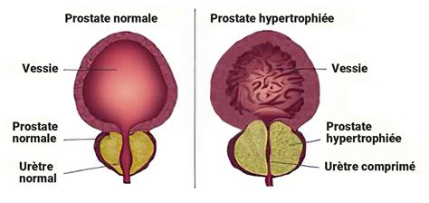 Sant Et Prostate Un Implant Pour Traiter Lhypertrophie B Nigne