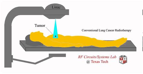 Conventional Radiotherapy Youtube