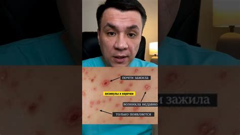 Как понять что у ребёнка ветрянка. - YouTube