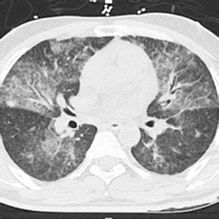 Case 1 CT Scan Of The Chest Showing Diffuse Ground Glass Airspace