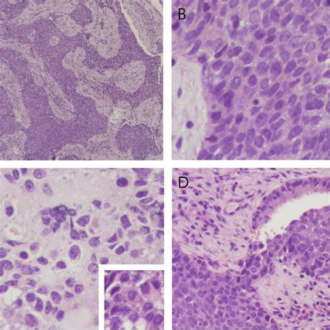 The Tumor Cells Revealed Positive For CK AE1 AE3 A P16 B And