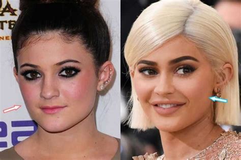 Kylie Jenner Before and after: Nose Job, Lip Injections, Breast