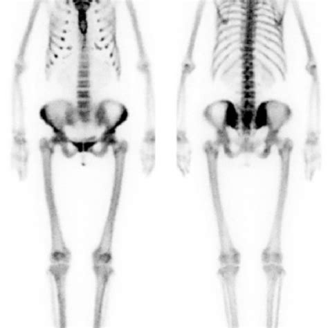 Figure Bone Scintigraphy 99m Tc Mdp The Diffuse And Uniform