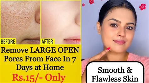 Remove Large Open Pores In 15 Days At Home Rid Blackheads And Whiteheads Large Pores Acne