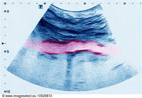 Atheromatous aorta Atheromatous aorta, sonography,examination medical ...