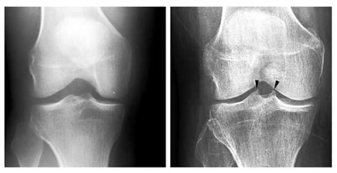 Diagnostics Free Full Text An Automatic Method For Assessing Spiking Of Tibial Tubercles