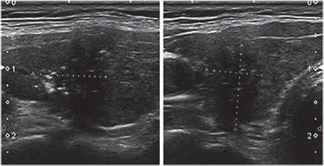 Role Of Elastography Strain Ratio And Tirads Score In Predicting