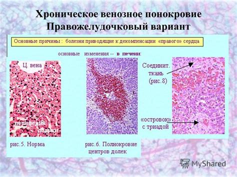 Презентация на тему: "Венозная гиперемия Типовой патологический процесс ...