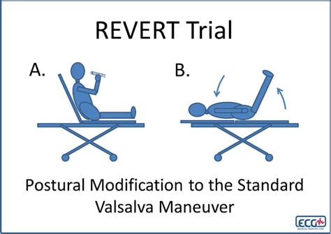Vagal Maneuvers Simplified — NUEM Blog