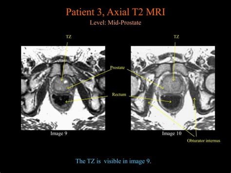 Prostate Mri Anatomy From University Of Michigan Ppt