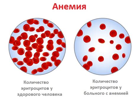Анемия у женщин– что это? Симптомы и лечение