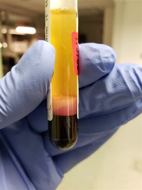 A Person In Blue Gloves Holding A Test Tube Filled With Yellow Liquid