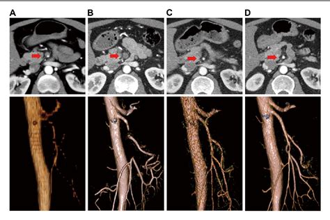 Figure 1 From Evolution Of Computed Tomographic Characteristics Of