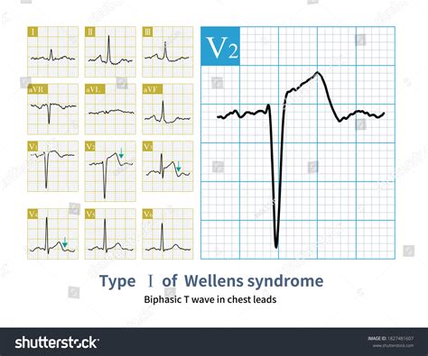 Electrocardiogram This Type Wellens Syndrome Characterized Stock ...