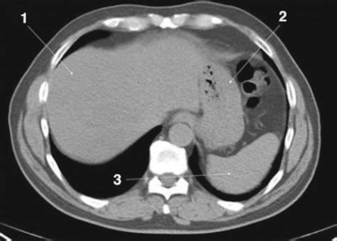 Imagenoncontrast Ct Scan Of The Abdomen And Pelvis Showing Normal Anatomy Slide 3 Msd Manual