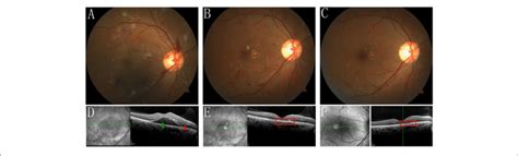 Fundus Photograph And Sd Oct Of The Right Eye During The Follow Up