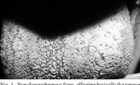 Figure 1 From Oral Geotrichosis Report Of 12 Cases Semantic Scholar