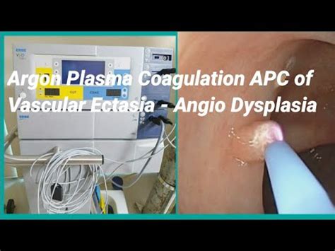 Angio Dysplasia Or Vascular Ectasia Argon Plasma Coagulation Apc