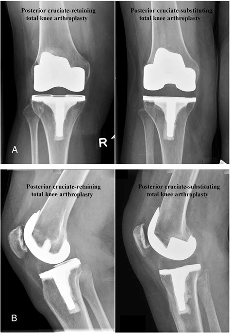 Ten Year Results Comparing Posterior Cruciate Retaining Versus